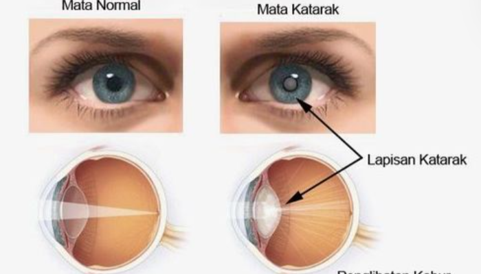 Penyakit Katarak Dapat Menyebabkan Kebutaan Jika Tak Di Obati