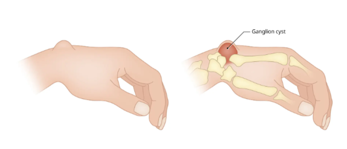 Penyakit Kista Ganglion Tidak Terlalu Membahayakan!