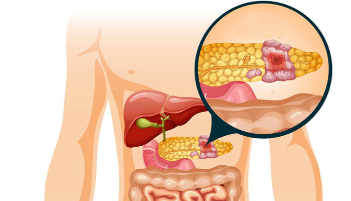 Penyakit Kanker Pankreas Menyebabkan Kelemahan Fisik