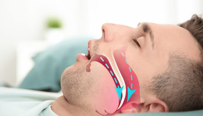 Penyakit Sleep Apnea Sangat Berbahaya, Mengapa Demikian?