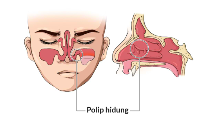 Polip Hidung Akan Sangat Menggangu Aktivitas Sehari-hari