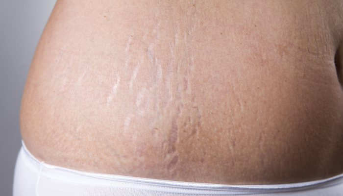 Stretch Mark Bisa Di Sebabkan Oleh Menggaruk Saat Haid, Fakta?