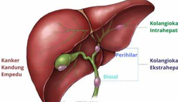 Kanker Empedu Berasal Dari Sel Ganas Pada Saluran Empedu