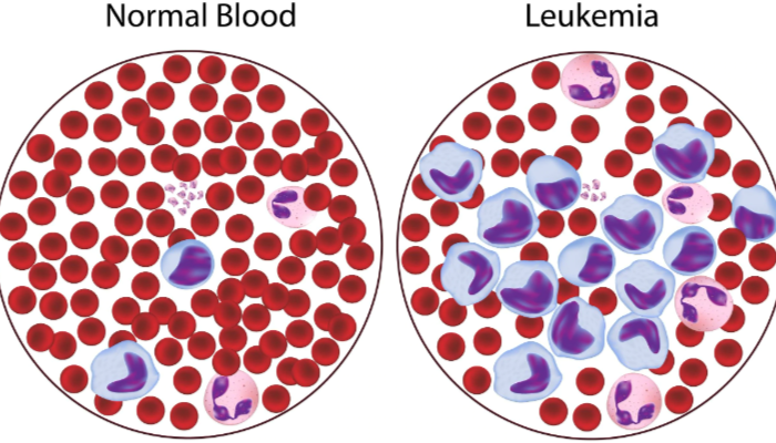 Penyakit Leukemia Bisa Menyebabkan Kematian, Cegah Segera!