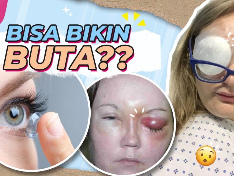 Bahaya Kontak Lensa